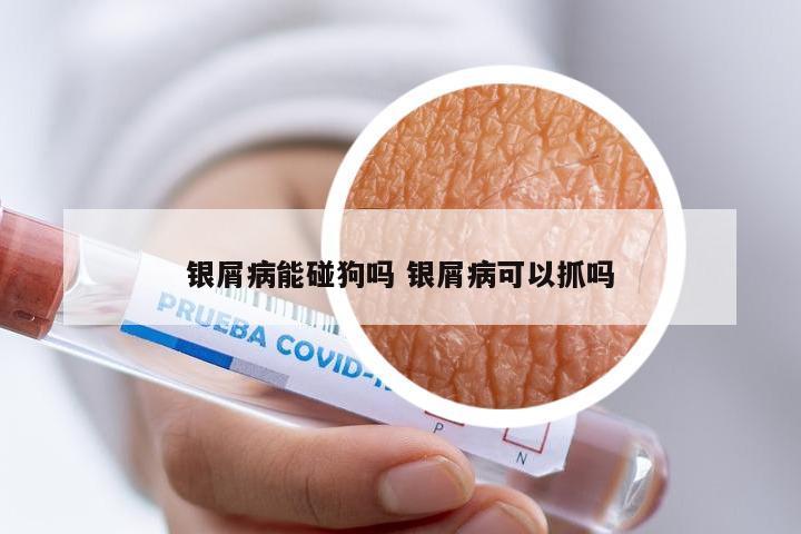银屑病能碰狗吗 银屑病可以抓吗
