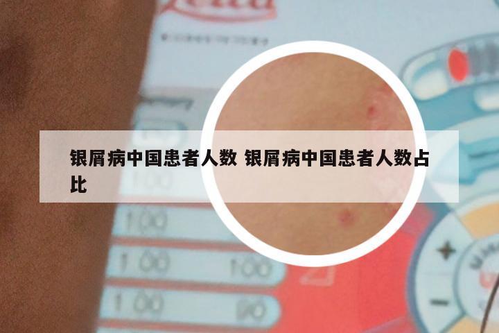 银屑病中国患者人数 银屑病中国患者人数占比
