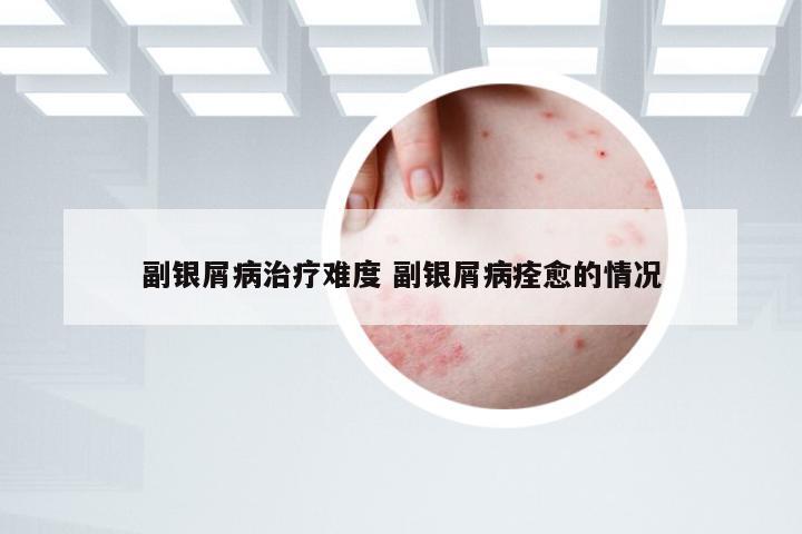 副银屑病治疗难度 副银屑病痊愈的情况
