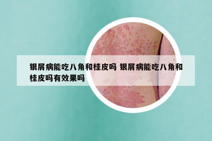 银屑病能吃八角和桂皮吗 银屑病能吃八角和桂皮吗有效果吗