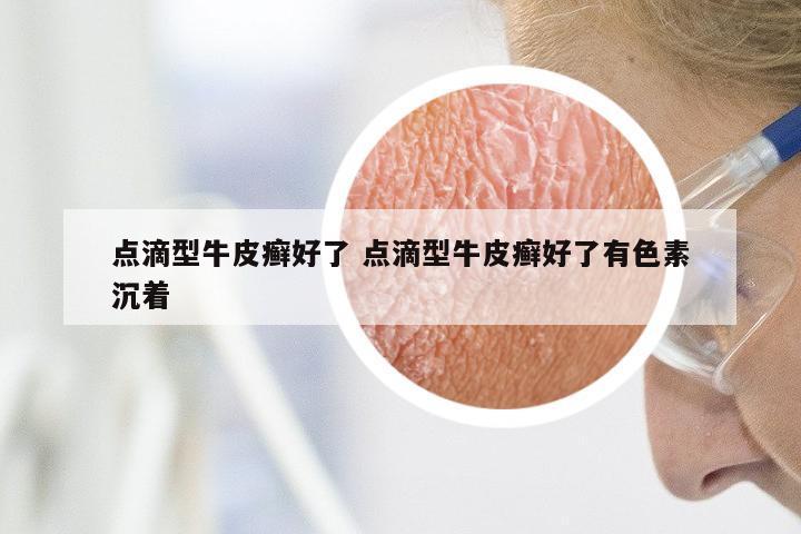 点滴型牛皮癣好了 点滴型牛皮癣好了有色素沉着