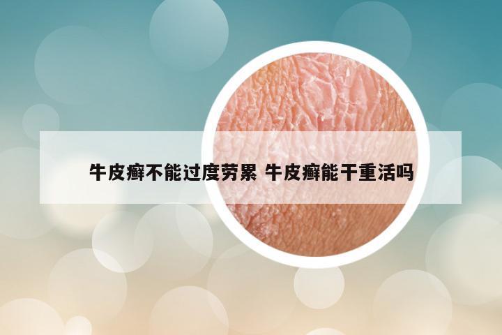 牛皮癣不能过度劳累 牛皮癣能干重活吗