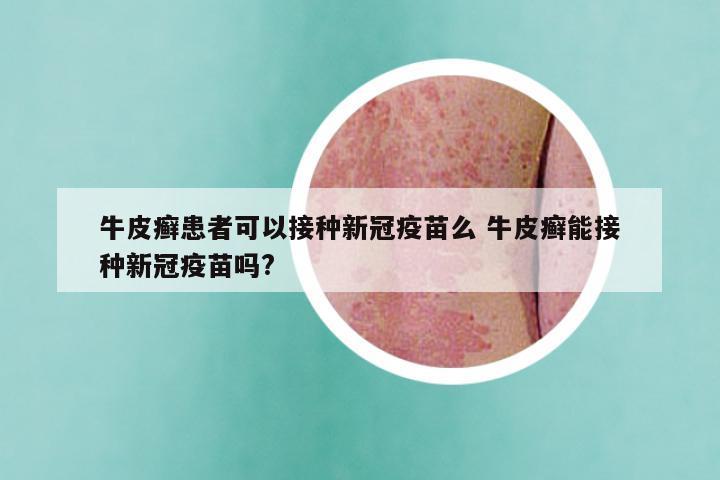 牛皮癣患者可以接种新冠疫苗么 牛皮癣能接种新冠疫苗吗?