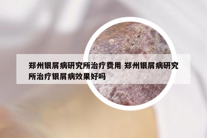 郑州银屑病研究所治疗费用 郑州银屑病研究所治疗银屑病效果好吗