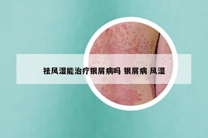 祛风湿能治疗银屑病吗 银屑病 风湿