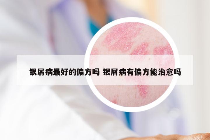 银屑病最好的偏方吗 银屑病有偏方能治愈吗