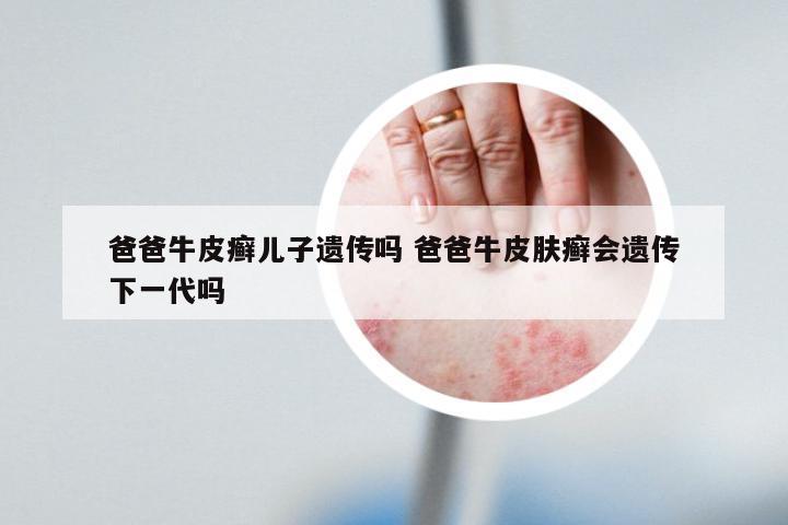 爸爸牛皮癣儿子遗传吗 爸爸牛皮肤癣会遗传下一代吗