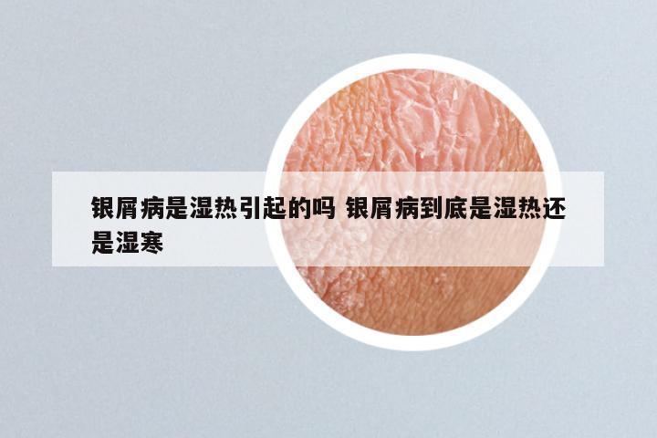 银屑病是湿热引起的吗 银屑病到底是湿热还是湿寒