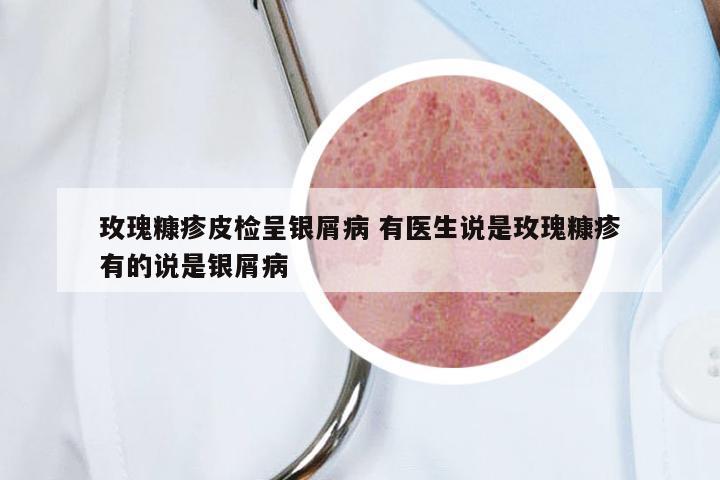 玫瑰糠疹皮检呈银屑病 有医生说是玫瑰糠疹有的说是银屑病