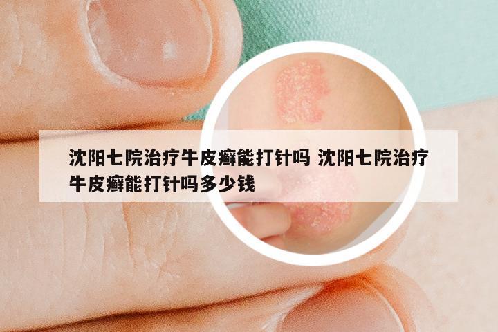 沈阳七院治疗牛皮癣能打针吗 沈阳七院治疗牛皮癣能打针吗多少钱