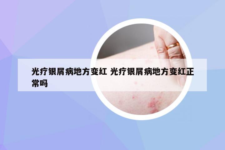 光疗银屑病地方变红 光疗银屑病地方变红正常吗