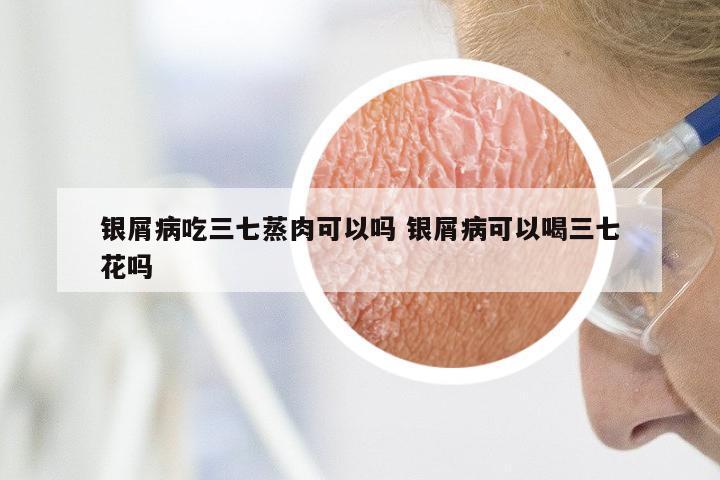 银屑病吃三七蒸肉可以吗 银屑病可以喝三七花吗