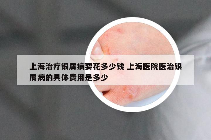 上海治疗银屑病要花多少钱 上海医院医治银屑病的具体费用是多少