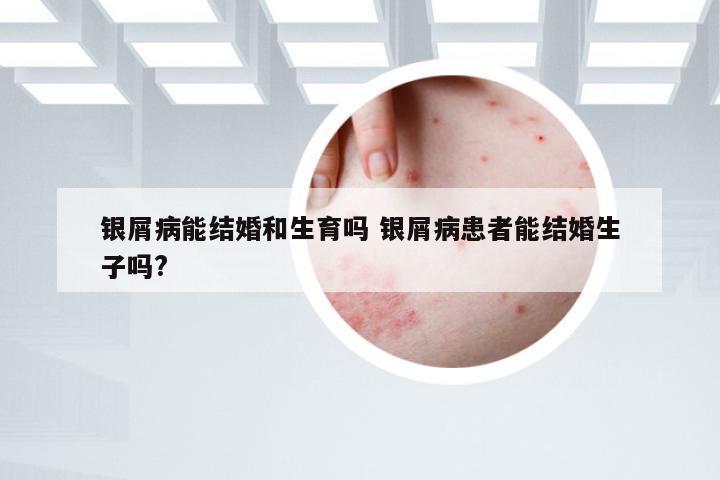 银屑病能结婚和生育吗 银屑病患者能结婚生子吗?