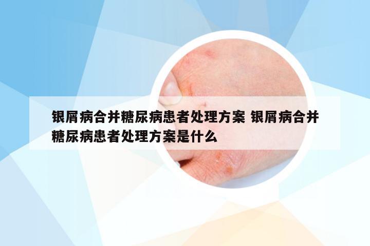 银屑病合并糖尿病患者处理方案 银屑病合并糖尿病患者处理方案是什么