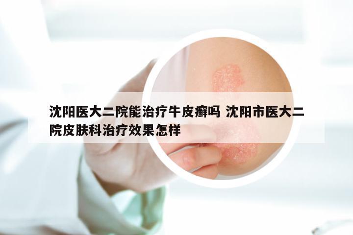 沈阳医大二院能治疗牛皮癣吗 沈阳市医大二院皮肤科治疗效果怎样