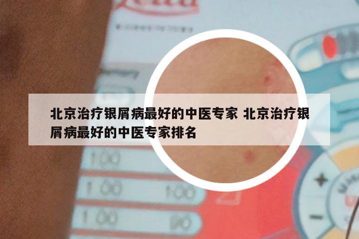 北京治疗银屑病最好的中医专家 北京治疗银屑病最好的中医专家排名