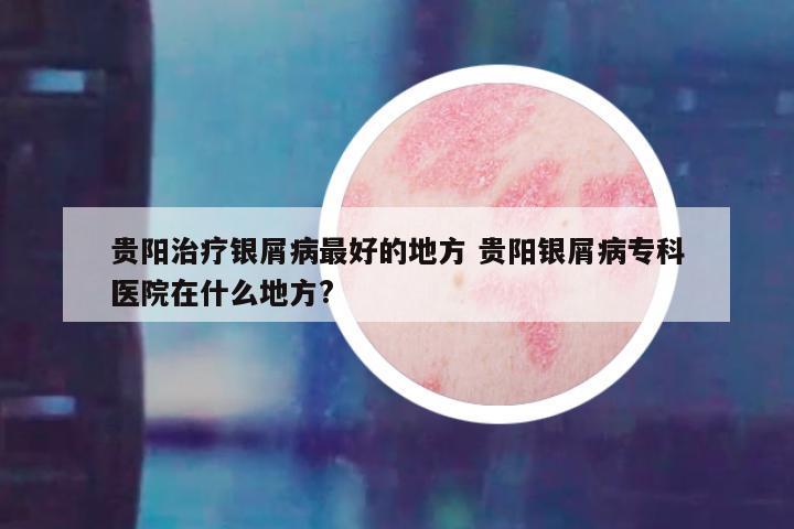 贵阳治疗银屑病最好的地方 贵阳银屑病专科医院在什么地方?