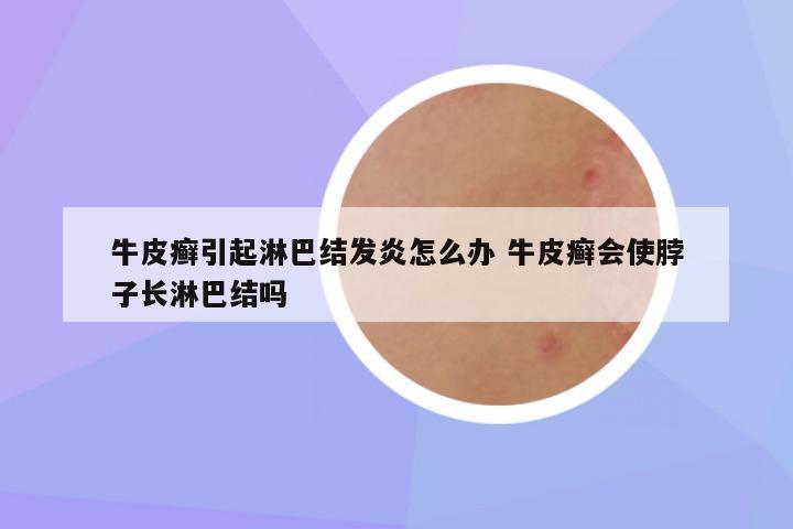 牛皮癣引起淋巴结发炎怎么办 牛皮癣会使脖子长淋巴结吗