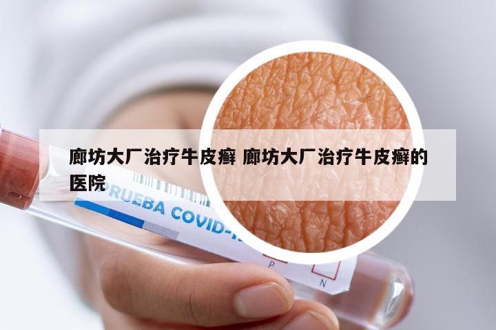 廊坊大厂治疗牛皮癣 廊坊大厂治疗牛皮癣的医院