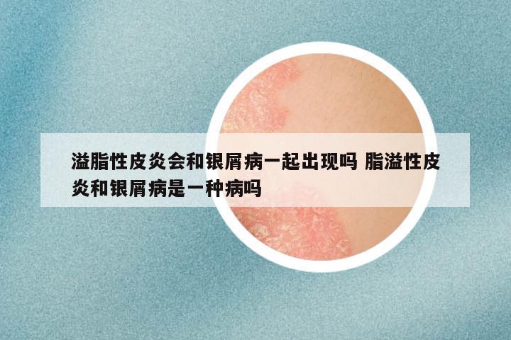 溢脂性皮炎会和银屑病一起出现吗 脂溢性皮炎和银屑病是一种病吗