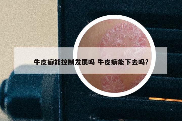 牛皮癣能控制发展吗 牛皮癣能下去吗?