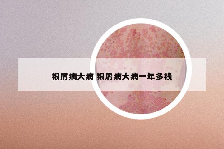 银屑病大病 银屑病大病一年多钱