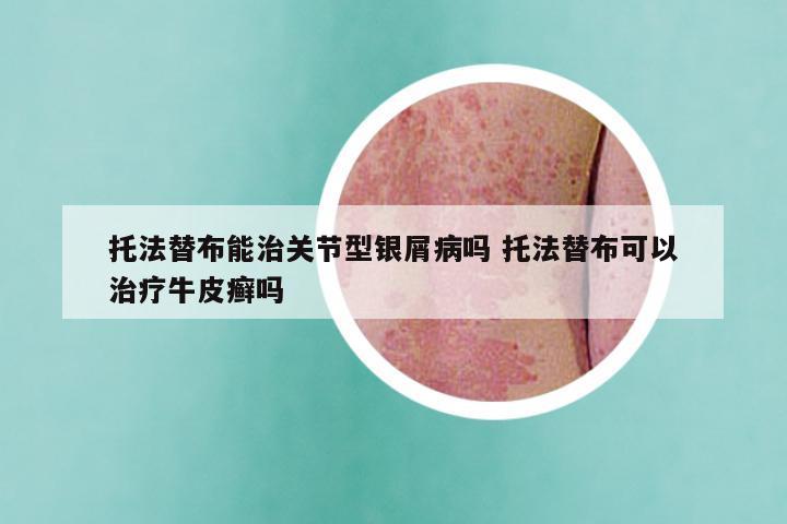 托法替布能治关节型银屑病吗 托法替布可以治疗牛皮癣吗