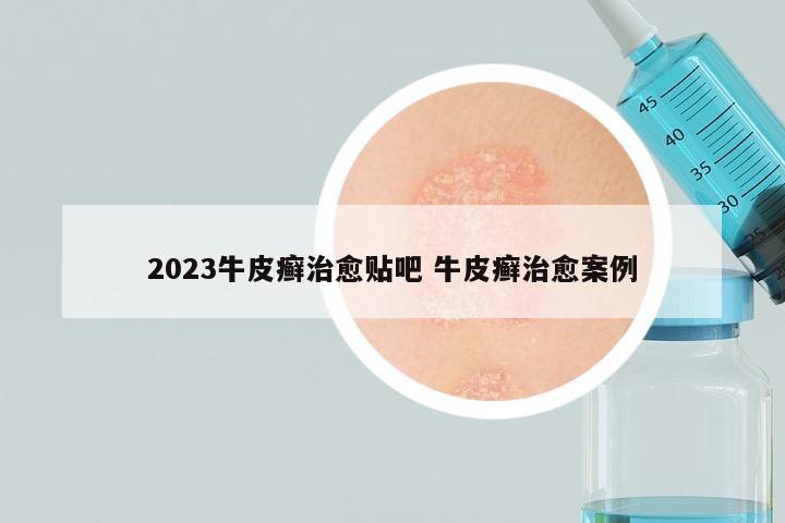 2023牛皮癣治愈贴吧 牛皮癣治愈案例