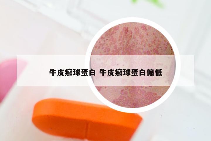 牛皮癣球蛋白 牛皮癣球蛋白偏低