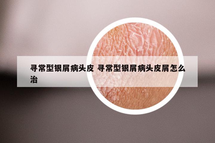 寻常型银屑病头皮 寻常型银屑病头皮屑怎么治