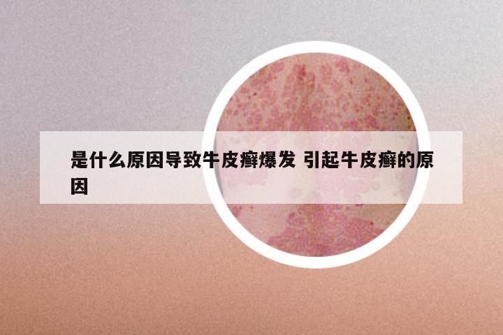 是什么原因导致牛皮癣爆发 引起牛皮癣的原因