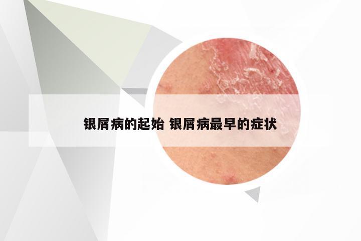 银屑病的起始 银屑病最早的症状