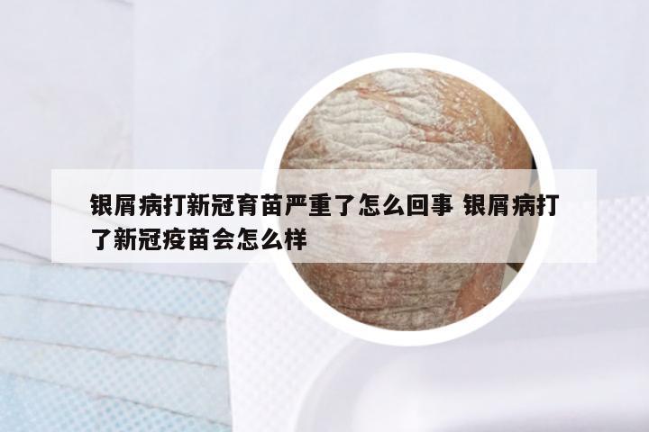 银屑病打新冠育苗严重了怎么回事 银屑病打了新冠疫苗会怎么样