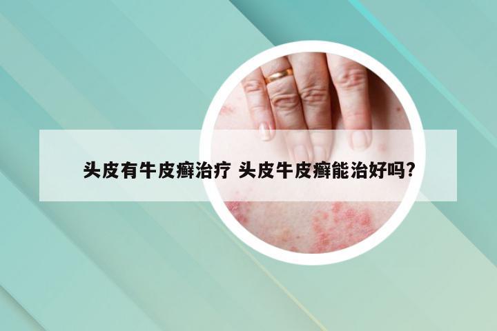 头皮有牛皮癣治疗 头皮牛皮癣能治好吗?