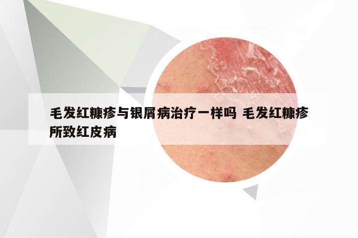 毛发红糠疹与银屑病治疗一样吗 毛发红糠疹所致红皮病