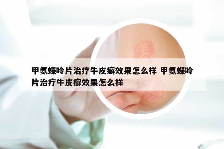 甲氨蝶呤片治疗牛皮癣效果怎么样 甲氨蝶呤片治疗牛皮癣效果怎么样