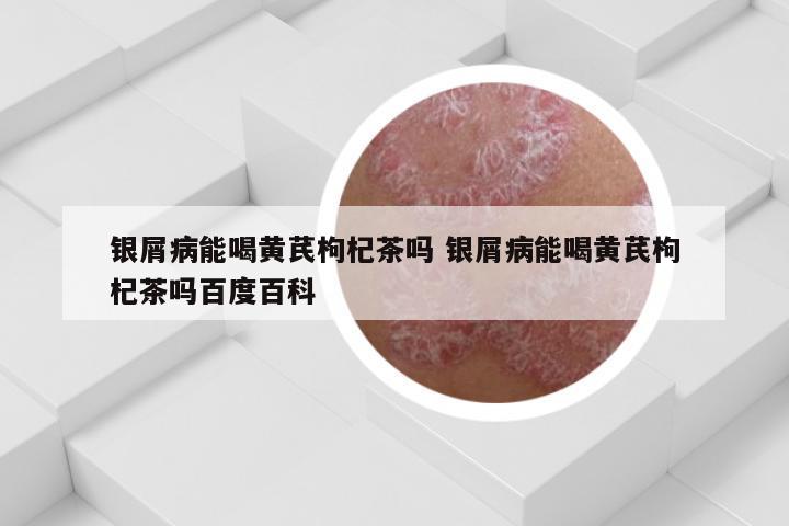银屑病能喝黄芪枸杞茶吗 银屑病能喝黄芪枸杞茶吗百度百科