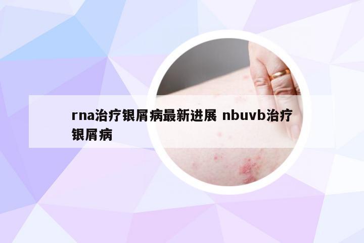 rna治疗银屑病最新进展 nbuvb治疗银屑病