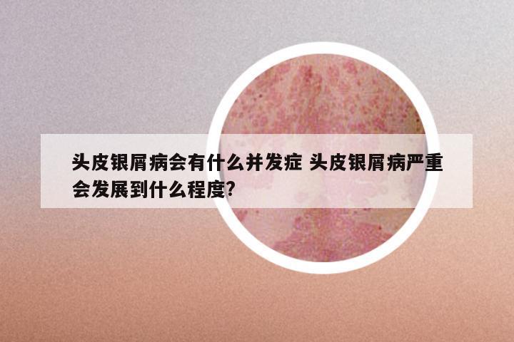 头皮银屑病会有什么并发症 头皮银屑病严重会发展到什么程度?