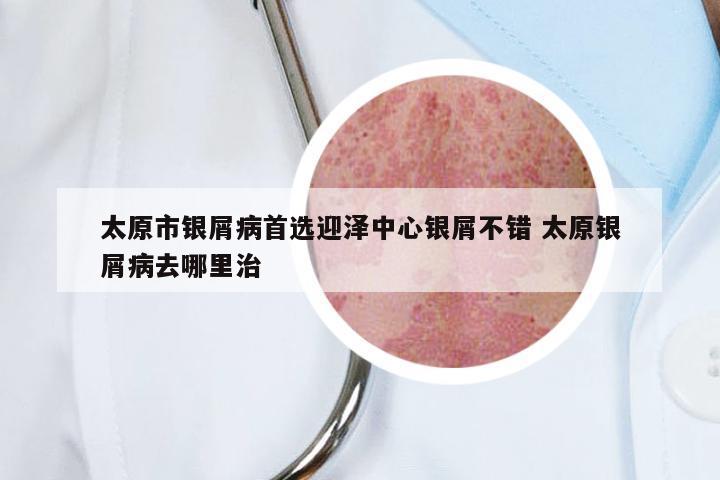 太原市银屑病首选迎泽中心银屑不错 太原银屑病去哪里治