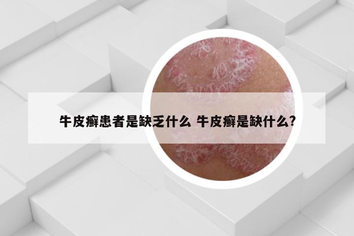 牛皮癣患者是缺乏什么 牛皮癣是缺什么?