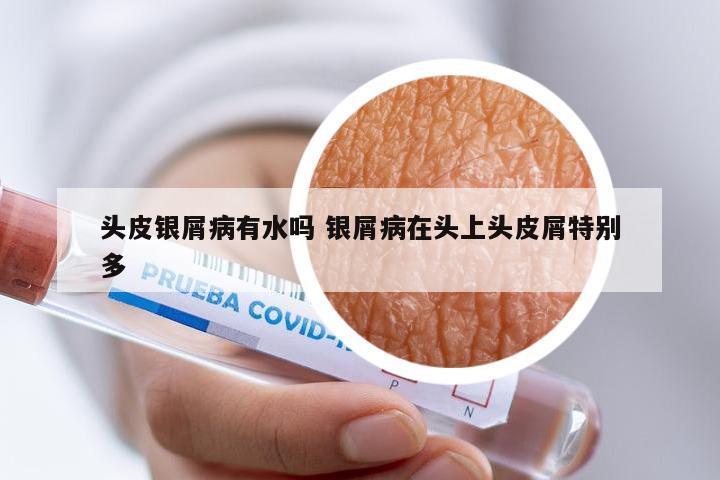 头皮银屑病有水吗 银屑病在头上头皮屑特别多