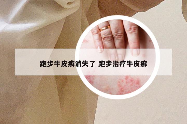 跑步牛皮癣消失了 跑步治疗牛皮癣