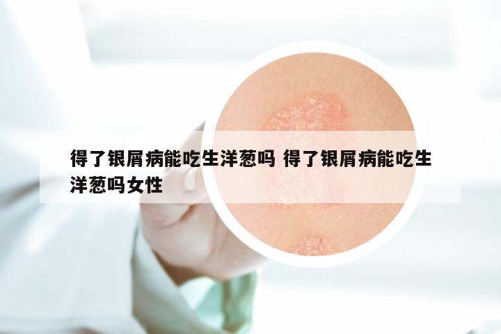 得了银屑病能吃生洋葱吗 得了银屑病能吃生洋葱吗女性