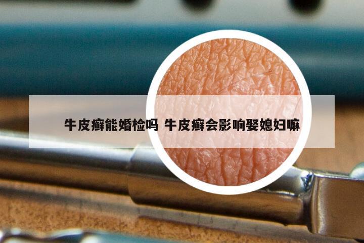 牛皮癣能婚检吗 牛皮癣会影响娶媳妇嘛
