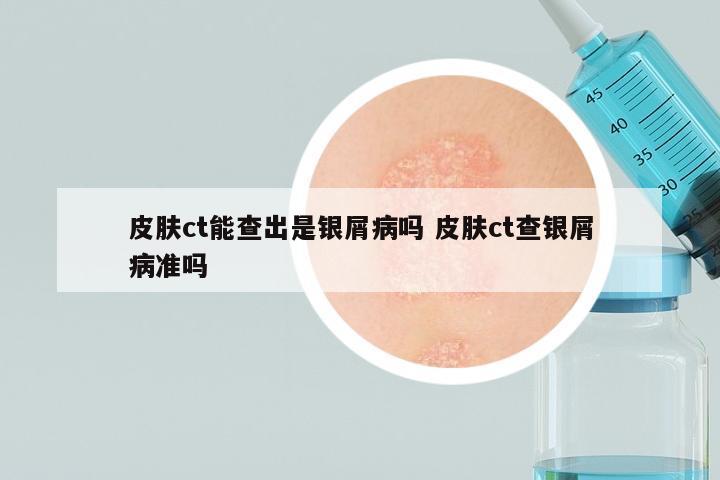 皮肤ct能查出是银屑病吗 皮肤ct查银屑病准吗