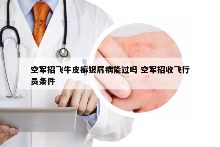 空军招飞牛皮癣银屑病能过吗 空军招收飞行员条件