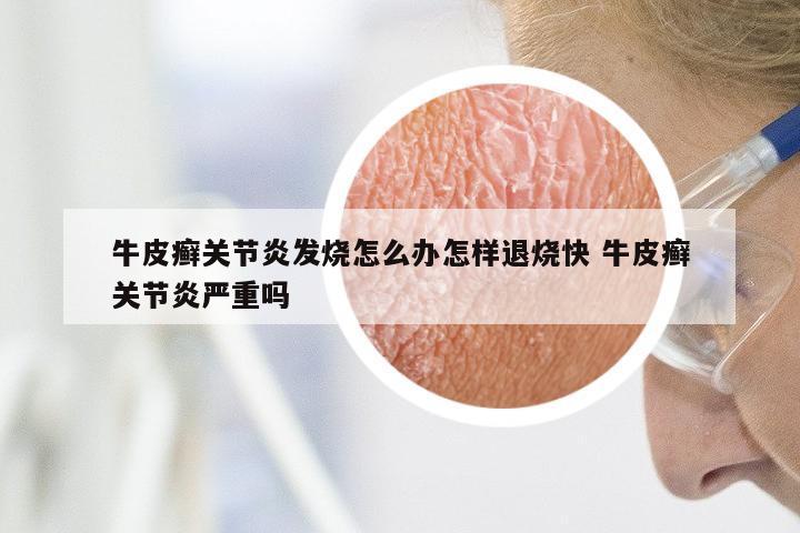 牛皮癣关节炎发烧怎么办怎样退烧快 牛皮癣关节炎严重吗