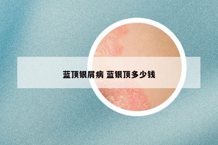 蓝顶银屑病 蓝银顶多少钱